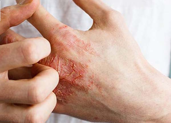 Tiếp xúc với các chất lạ có thể khiến bạn bị viêm da tiếp xúc kích ứng