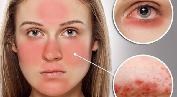 Những điều cần biết về bệnh Lupus ban đỏ hệ thống