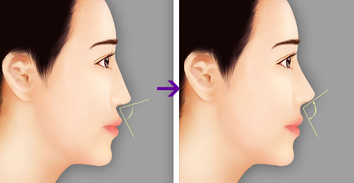 Sử dụng mũi tự thân từ vách ngăn giúp dáng mũi cao vào không quá hếch 