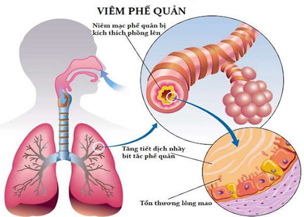 Viêm phế quản là tình trạng các ống dẫn khí ở hệ hô hấp dưới bị viêm lớp niêm mạc