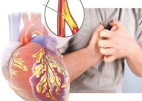 Đau thắc ngực là biểu hiện triệu chứng của thiếu máu và nhồi máu cơ tim (ảnh minh họa)