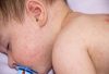 Có được tắm cho trẻ khi trẻ bị sốt phát ban hay không?