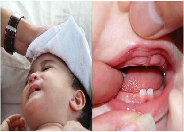 Cách phân biệt nhanh giữa sốt do mọc răng với sốt thông thường