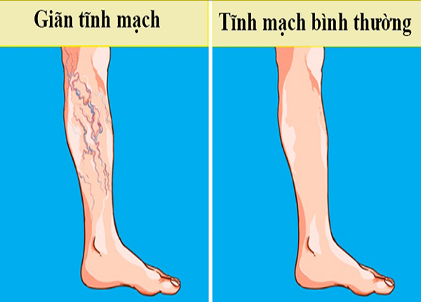 Giãn tĩnh mạch xảy ra phần lớn là ở phần chi dưới hay còn gọi giãn tĩnh mạch chân
