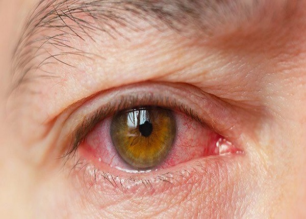 Thuốc mỡ tra mắt thường được chỉ định điều trị các bệnh nhiễm khuẩn ở mắt